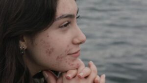 Read more about the article The Complete Science Behind Acne: 5 Key Causes, Stages, Risk Factors & Myths