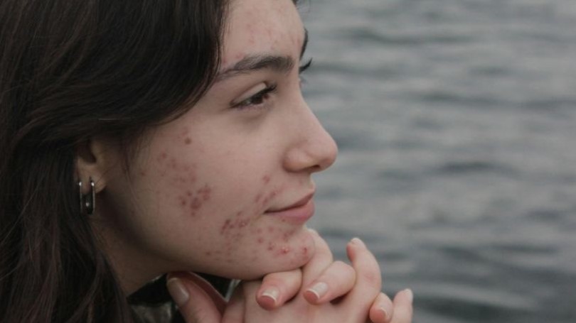 Read more about the article The Complete Science Behind Acne: 5 Key Causes, Stages, Risk Factors & Myths