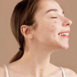 Why is my Acne worse after starting salicylic acid? (Purging vs breakout explained)