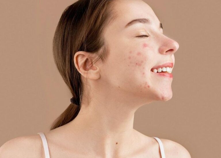 Acne worse after starting salicylic acid - Purging